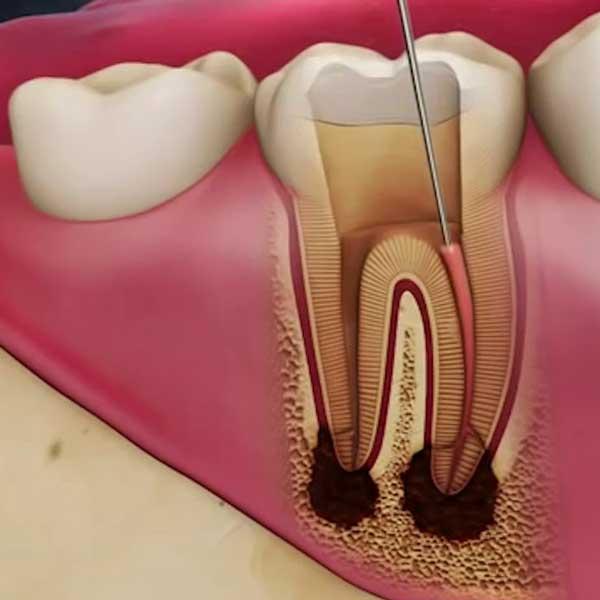 اللبية - علاج جذور الأسنان