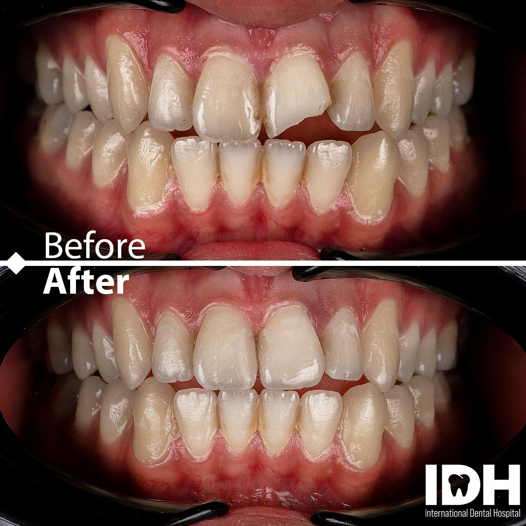 International Dental Hospital Before-After Picture