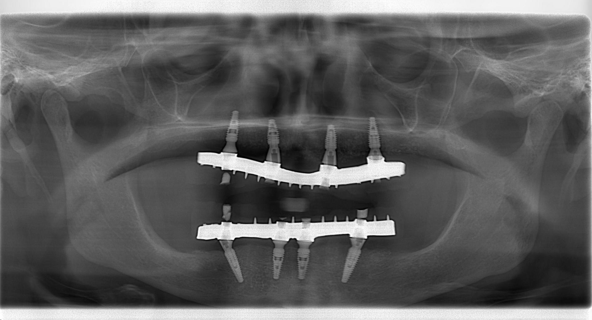 Turkey Dental Implant Antalya