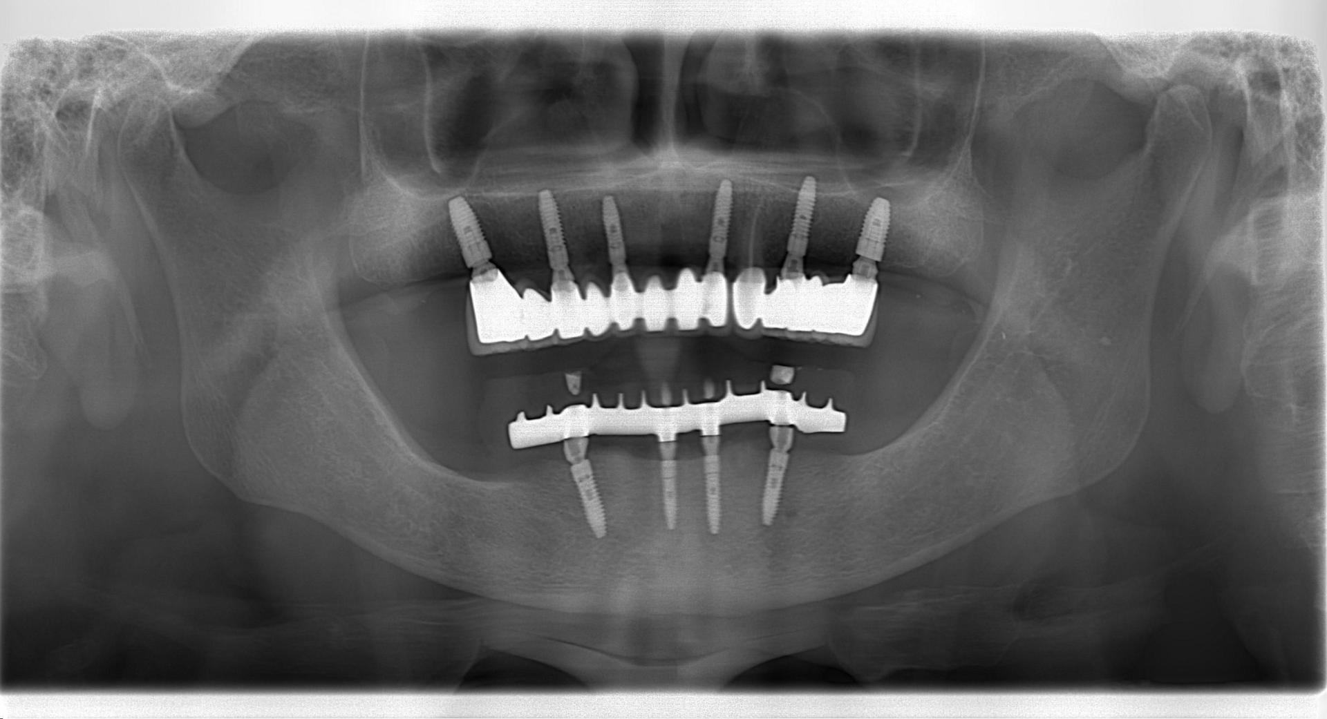 Turkey Dental Implant Antalya All on Four