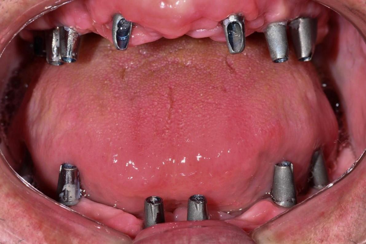 Turkey Dental Implant Antalya